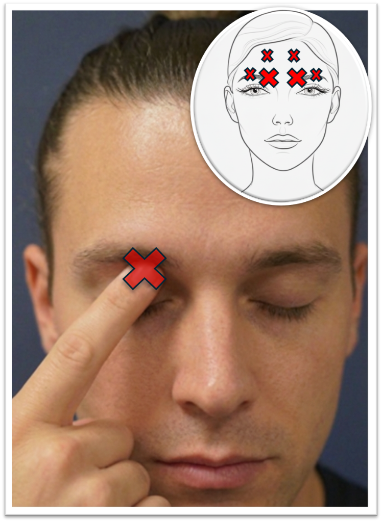 Frontal trigger point