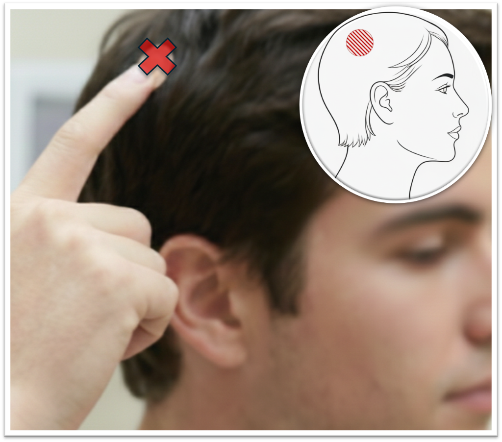 Nummular trigger point