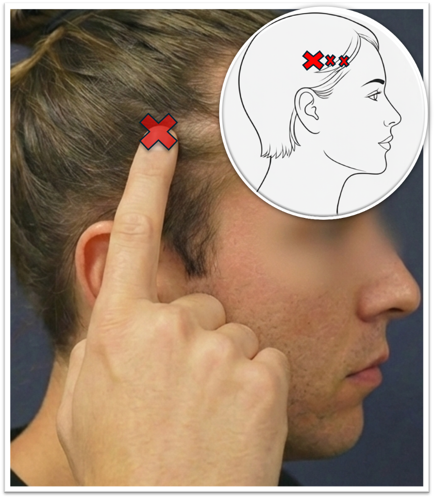 Temporal trigger point