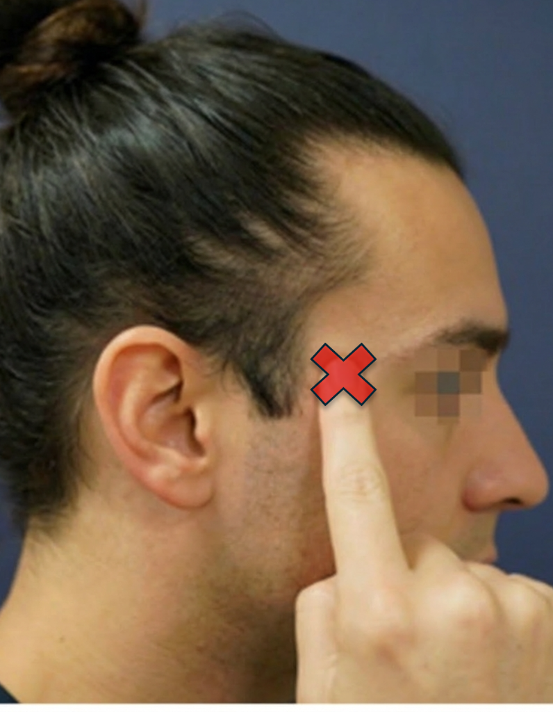 Temporal Migraine View 1